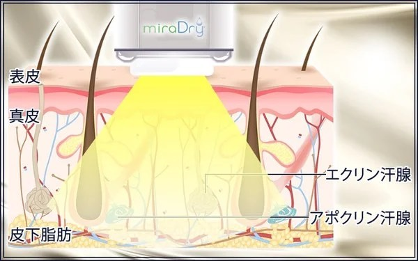 ミラドライ照射の仕組み